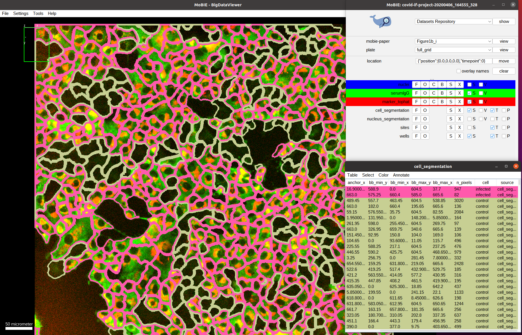 Cell segmentation overlay with infection classification and serum